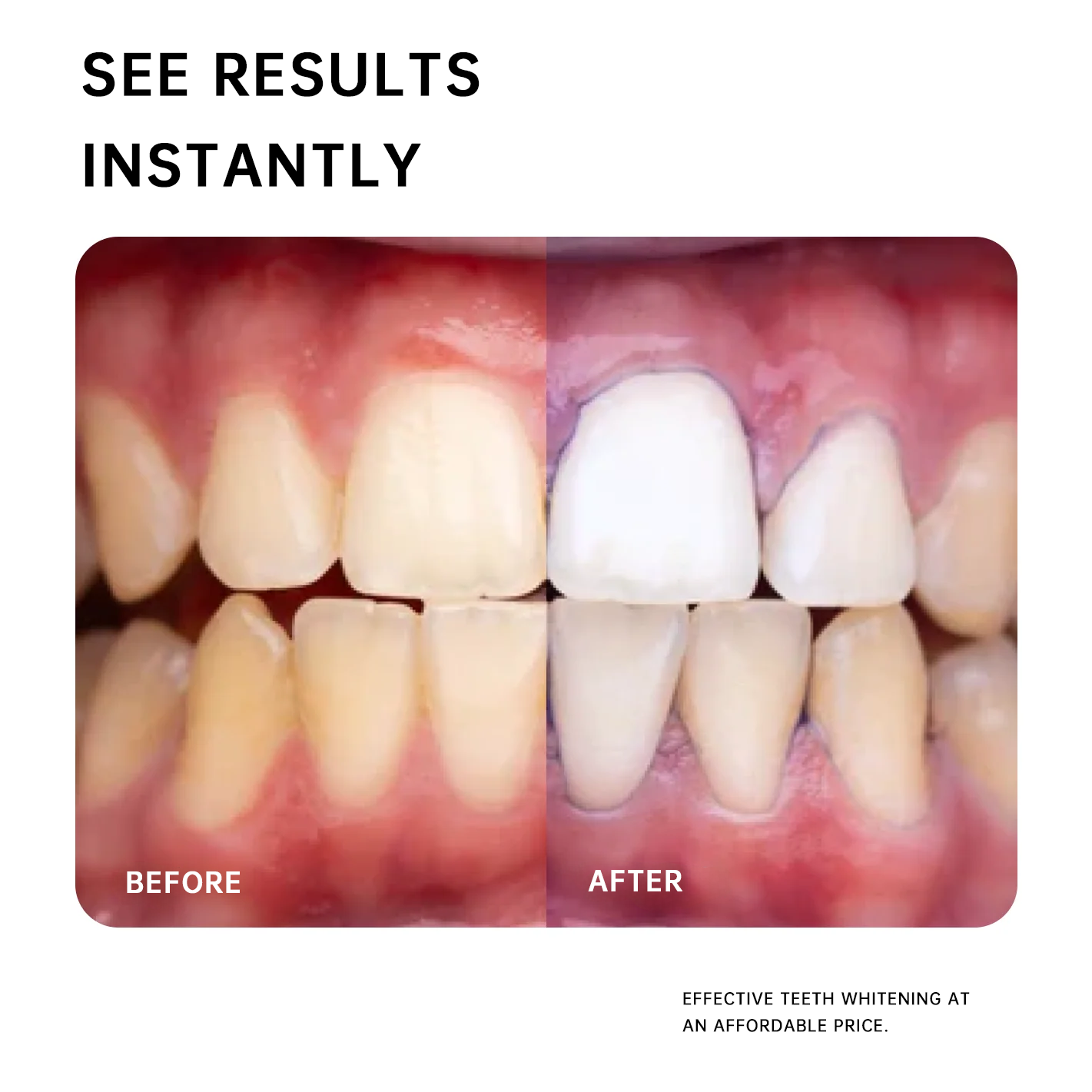 NESLEMY PURPLE - Teeth Whitening